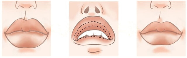 Контурная пластика губ (хейлопластика)